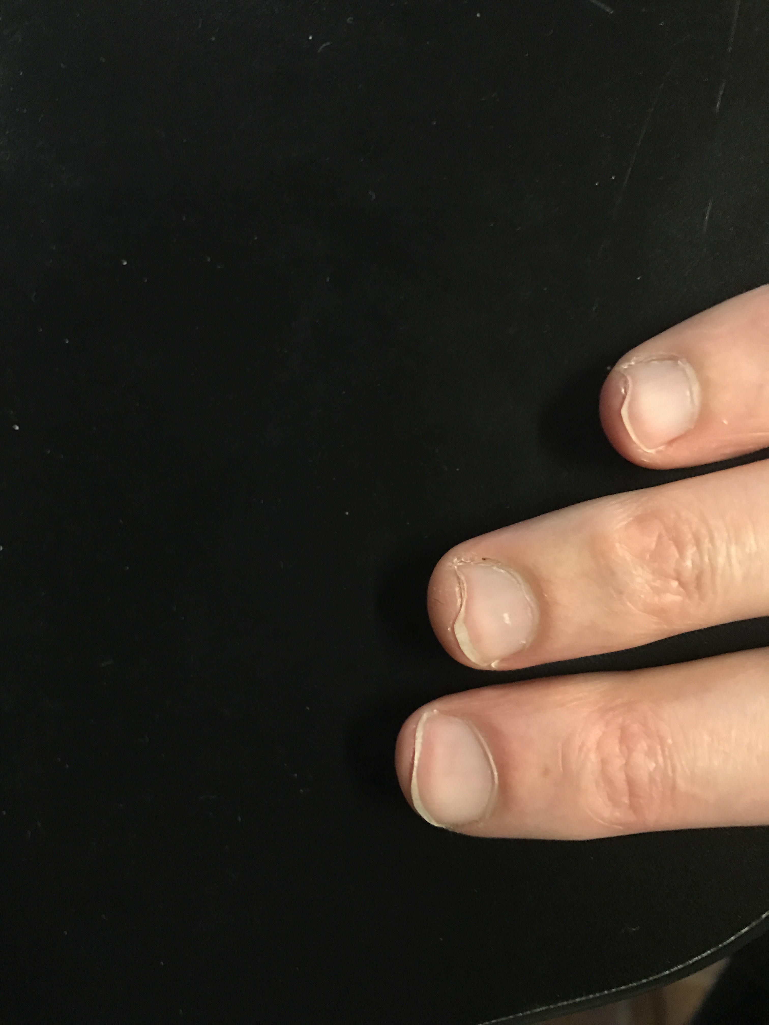 Hybrid picking nails problem Playing Technique The Cracking