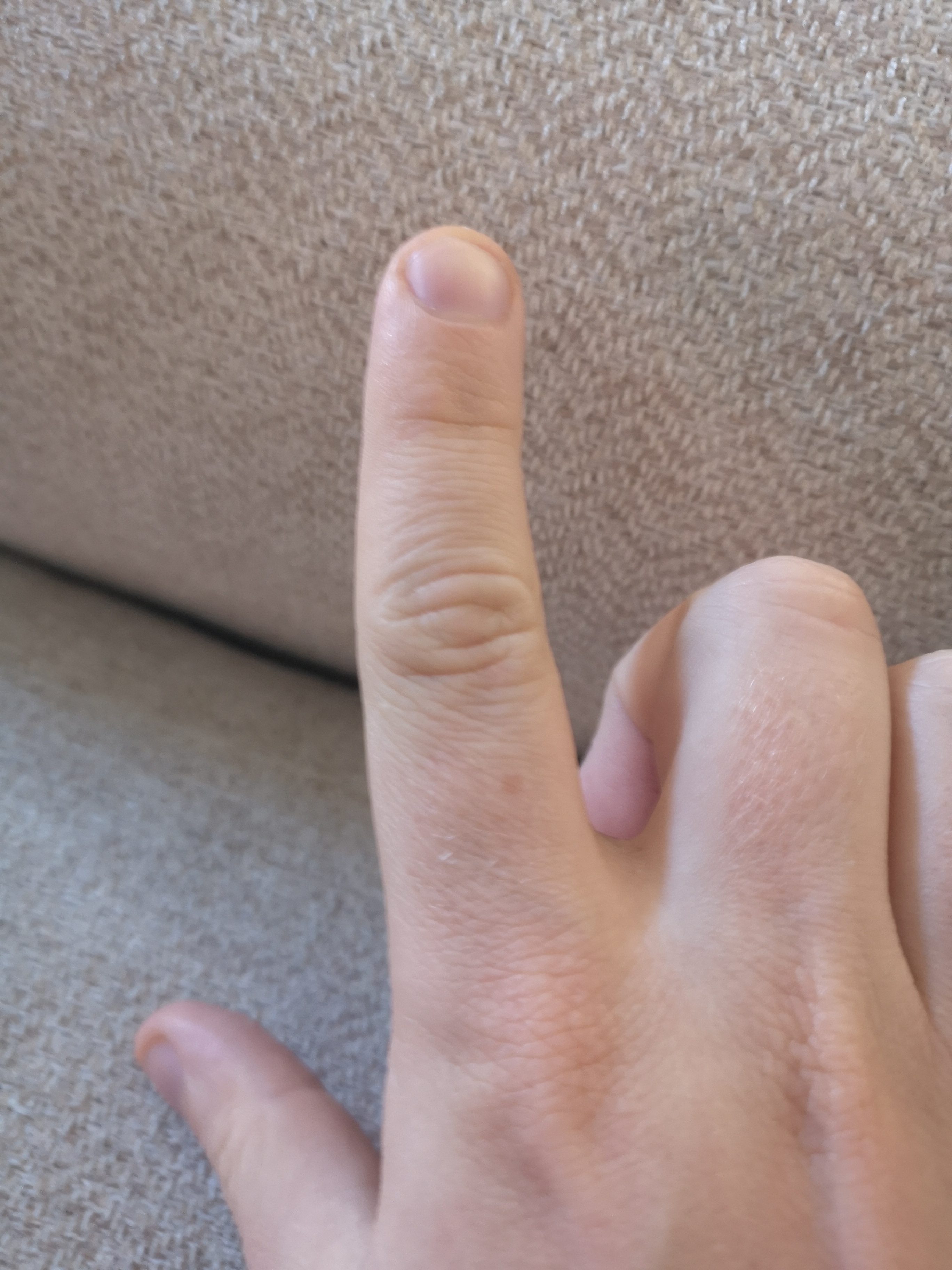 Do You Have Trigger Finger? | University of Utah Health